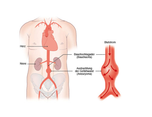 Vorsorge Bauchaorta